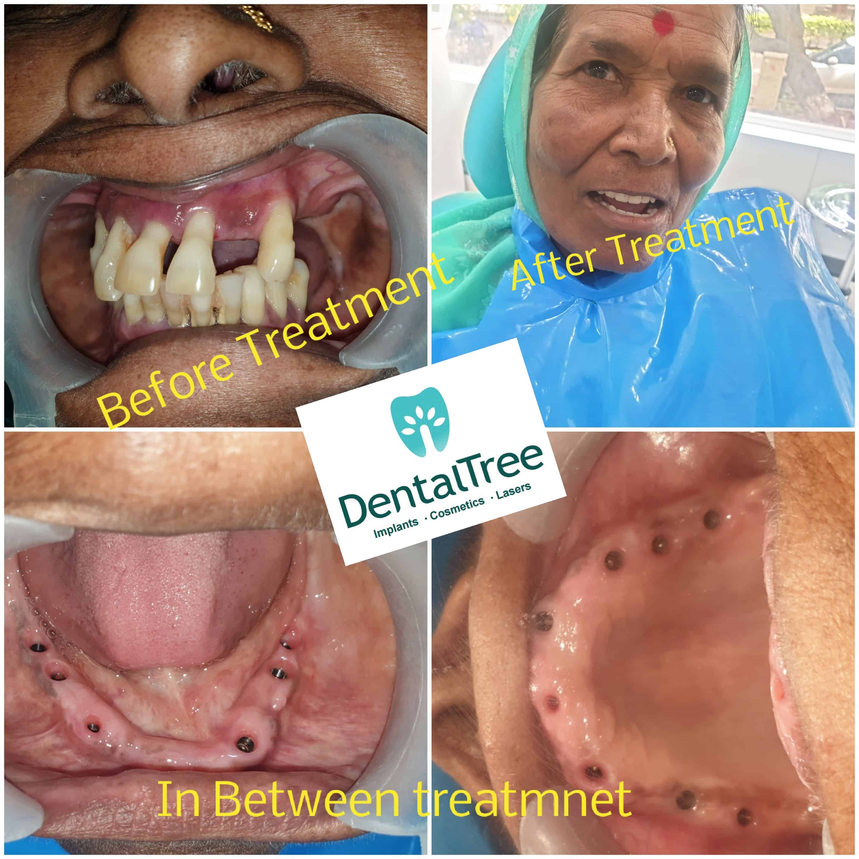 Dentist Treating a patient in Aundh, Pune Clinic