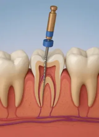 Endodontics Treatments in Pune