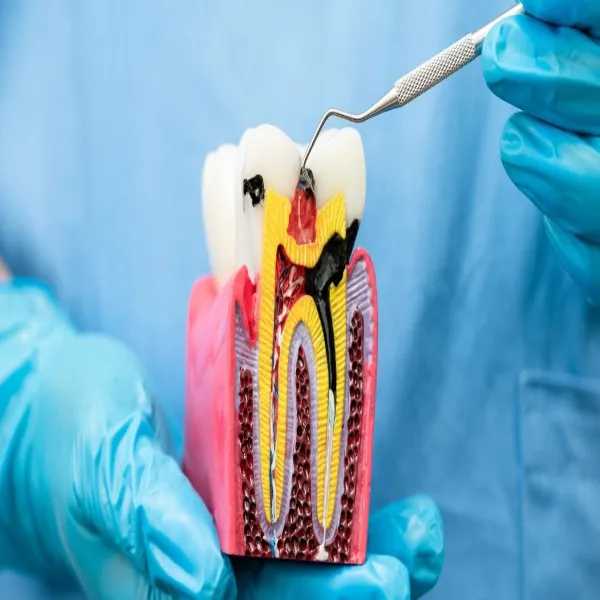 Endodontics Treatments in Pune
