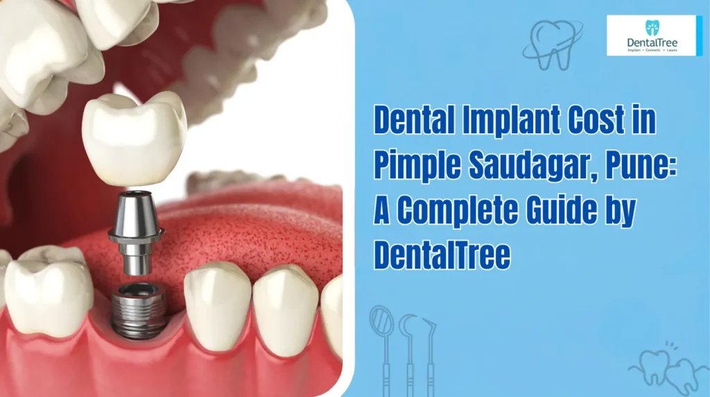 Dental Implant Cost in Pimple Saudagar, Pune